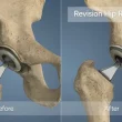 Revision Hip Replacement