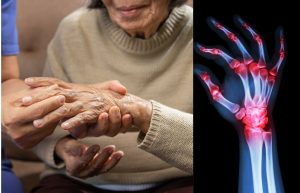 Blood Tests Uncover Hidden Arthritis