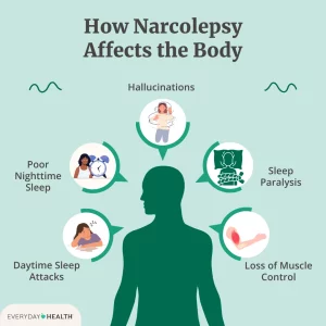 Narcolepsy Type 1