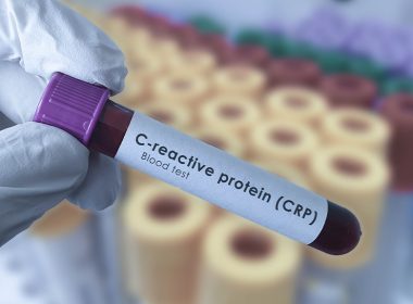 Blood Tests Uncover Hidden Arthritis