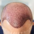 FUT hair transplant in Islamabad.