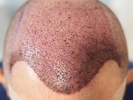 FUT hair transplant in Islamabad.