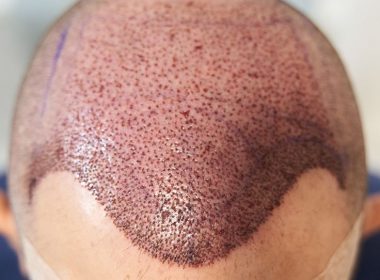 FUT hair transplant in Islamabad.