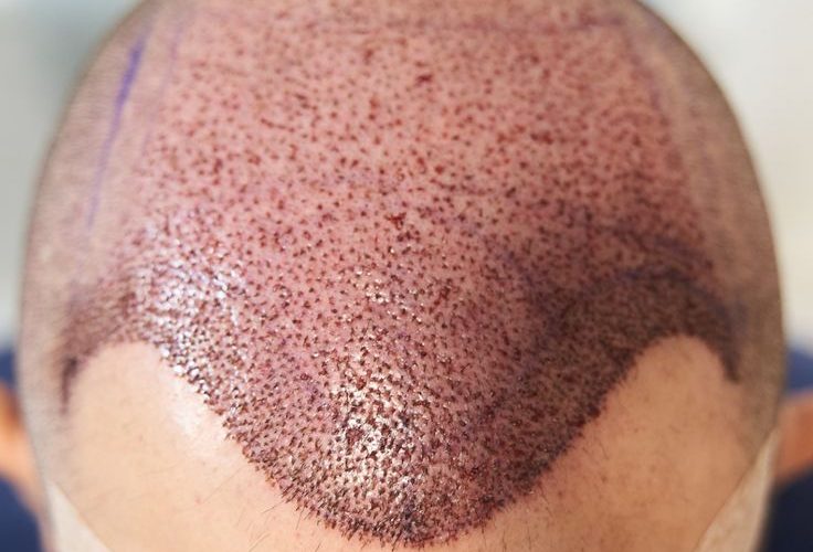 FUT hair transplant in Islamabad.