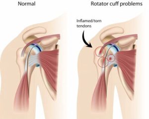 rotator-cuff