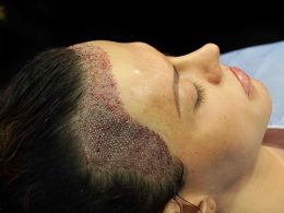 FUE Hair Transplant in Islamabad