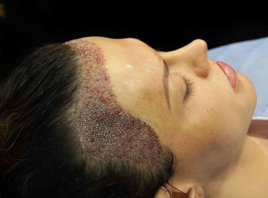 FUE Hair Transplant in Islamabad