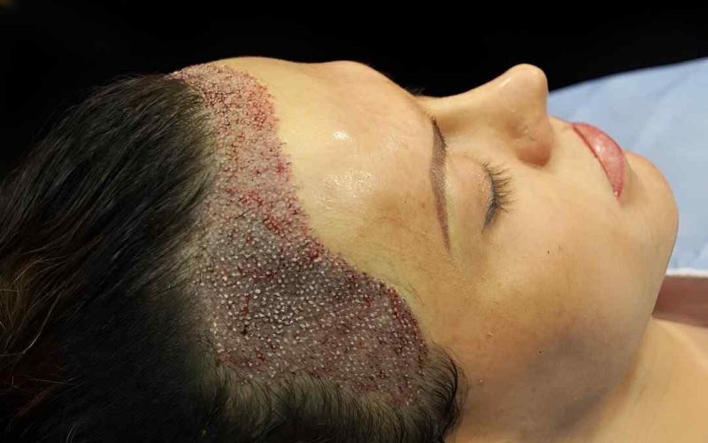 FUE Hair Transplant in Islamabad