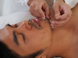 Facial Acupuncture