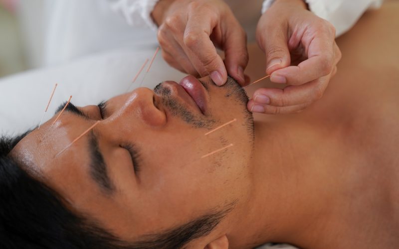 Facial Acupuncture