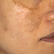 Hyperpigmentation