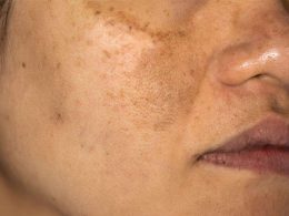 Hyperpigmentation