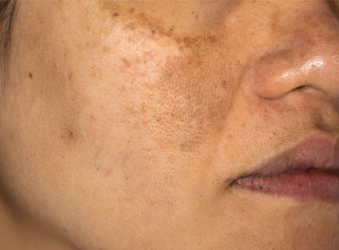 Hyperpigmentation