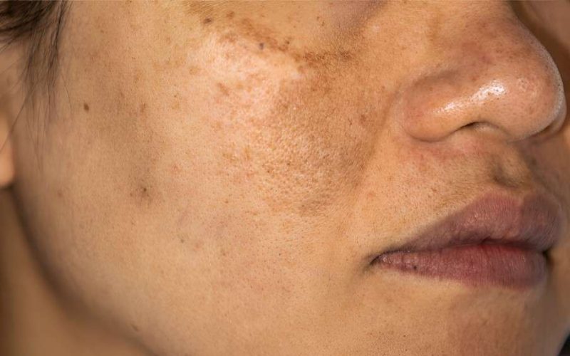 Hyperpigmentation