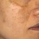 Hyperpigmentation