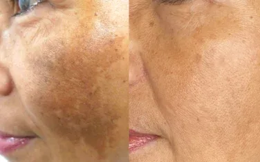 Melasma Treatment