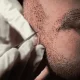 Hair Transplant