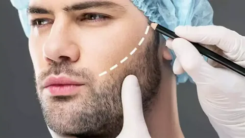 Hair Transplant