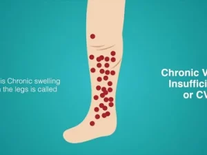 Chronic venous insufficiency