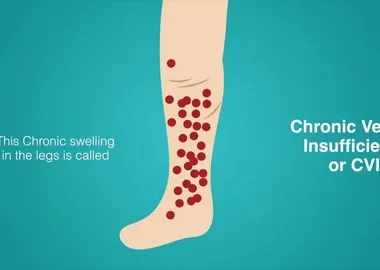 Chronic venous insufficiency