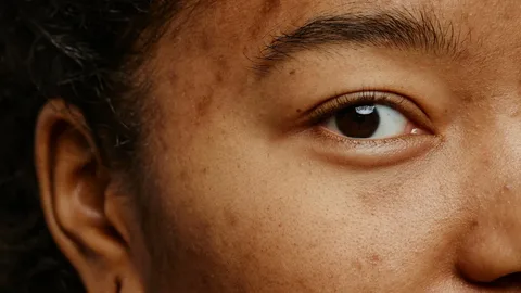 Hyperpigmentation Treatment