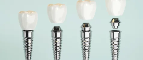 Implant Screws