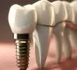 Implant Screws