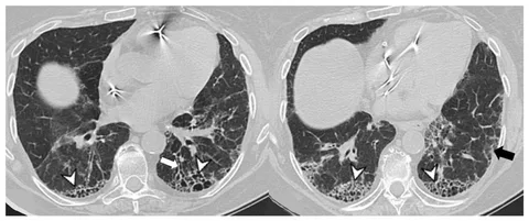 Interstitial Lung Disease