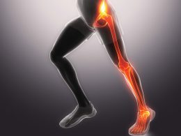 Knee Arthritis