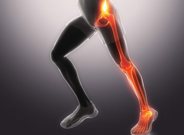 Knee Arthritis