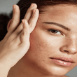 melasma treatment in Islamabad