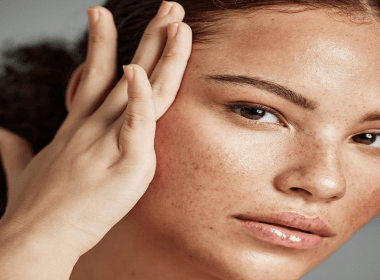 melasma treatment in Islamabad