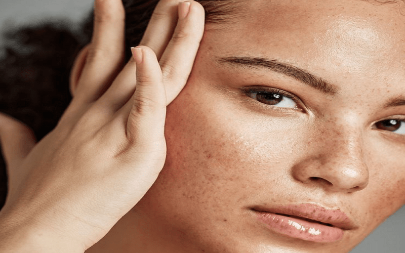 melasma treatment in Islamabad