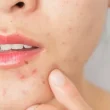 Acne Treatment