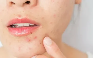 Acne Treatment