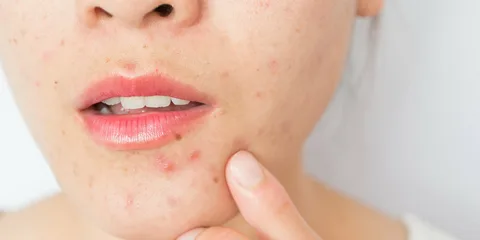 Acne Treatment
