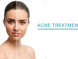 Dermatologist-Acne Treatments