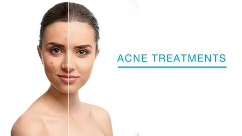 Dermatologist-Acne Treatments