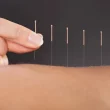 Acupuncture
