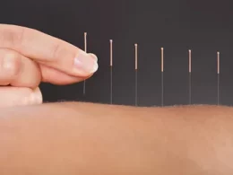 Acupuncture