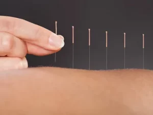 Acupuncture