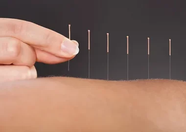 Acupuncture
