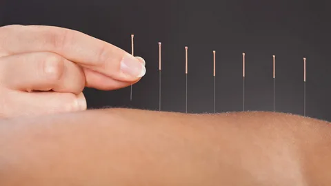 Acupuncture
