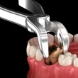 tooth extraction