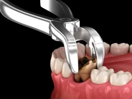 tooth extraction
