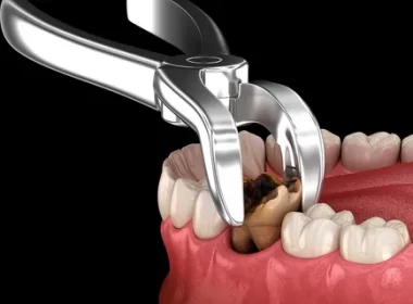 tooth extraction