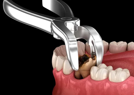 tooth extraction