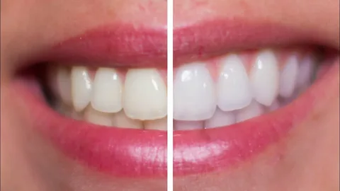 laser whitening