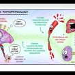 Preeclampsia
