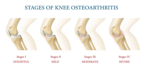 knee osteoarthritis